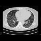 Idiopathic lung fibrosis: CT - Computed tomography